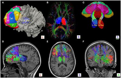 Human Thalamic-Prefrontal Peduncle Connectivity Revealed by Diffusion Spectrum Imaging Fiber Tracking